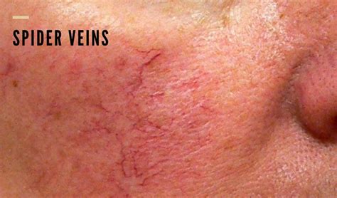 Broken Blood Vessels Around Eyes - Vein Solutions