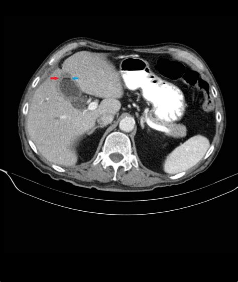 Perforated Gallbladder Ultrasound