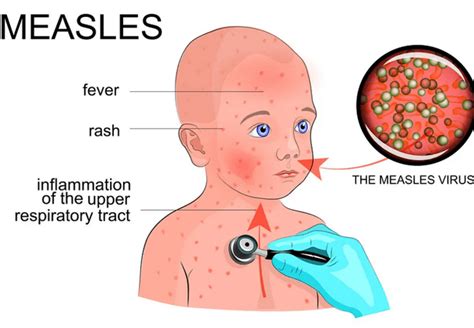 Measles Disease: Symptoms, Sign, Diagnosis and Treatment