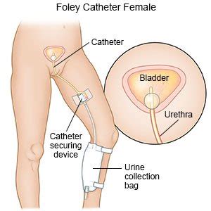 Catheter Drainage Bag Position - Best Drain Photos Primagem.Org