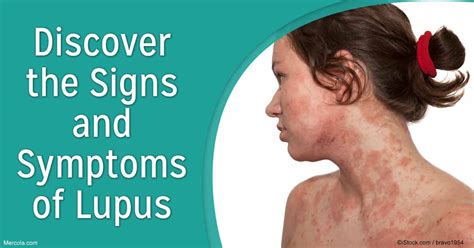 What Are the Signs and Symptoms of Lupus?