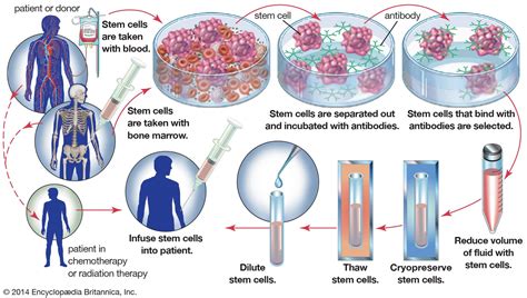 Bone marrow transplant | Benefits, Risks & Procedure | Britannica