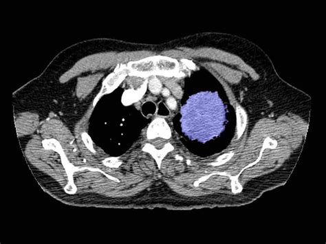 Why Some Doctors Hesitate To Screen Smokers For Lung Cancer : Shots ...