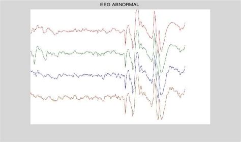 What Does An Abnormal Eeg Look Like