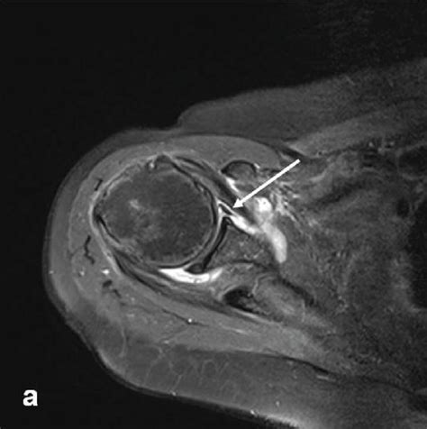 A transverse (a) T2-weighted MRI view shows a Bankart lesion (white ...