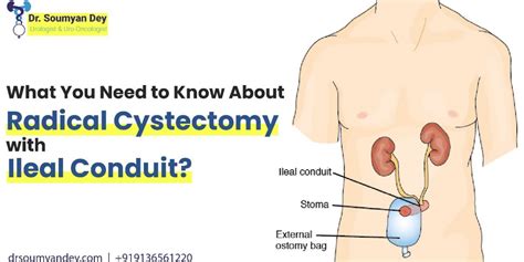 Understanding Radical Cystectomy with Ileal Conduit