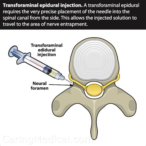 Spinal Epidural Steroid Injection