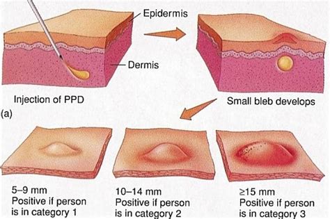 Tuberculin Skin Test (Positive Mantoux Test) Result, Reading and ...