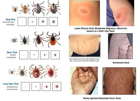 Lyme disease, Tick rash, Ticks