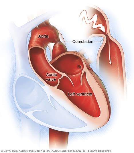 Coarctation Of Aorta Turner Syndrome - Captions Hunter