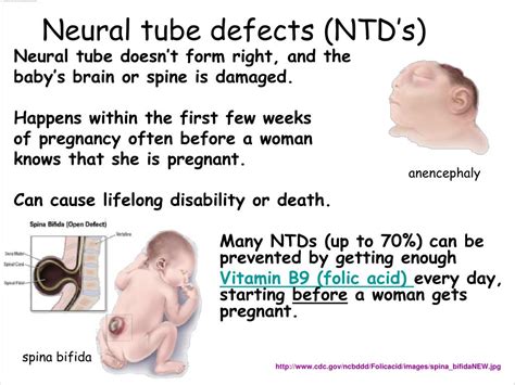 PPT - Neural tube defects (NTD’s) PowerPoint Presentation, free ...