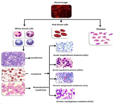 Types of leukemia in blood. | Download Scientific Diagram