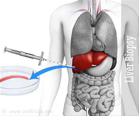 Liver Biopsy - References