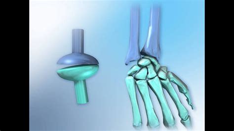 Condyloid Joint Anatomy