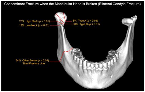 JCM | Free Full-Text | Current Frequency of Mandibular Condylar Process ...