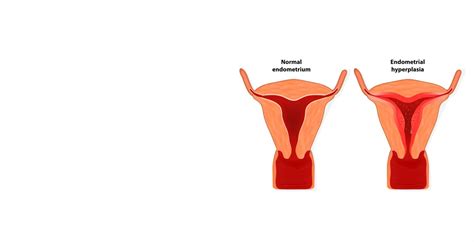 Endometrial Hyperplasia (Thick Endometrium) Causes & Treatment | Indira IVF