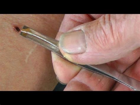 How to remove a tick. | Deer ticks, Tick removal, Ticks