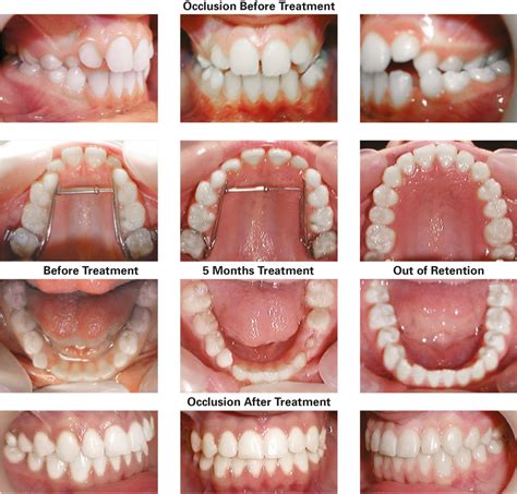 TransForce Palatal Expander - TransForce Orthodontics - Dr William Clark