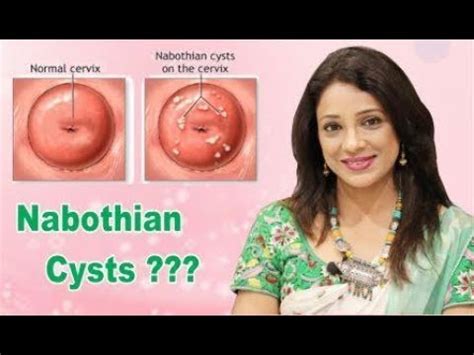 Nabotovy Cysts Of The Cervix: Symptoms, Treatment, Photo | Diseases 2024