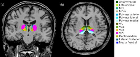 Thalamic nuclei volumes and intrinsic thalamic network in patients with ...