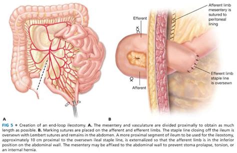 End and Diverting Loop Ileostomies: Creation and Reversal | Abdominal Key