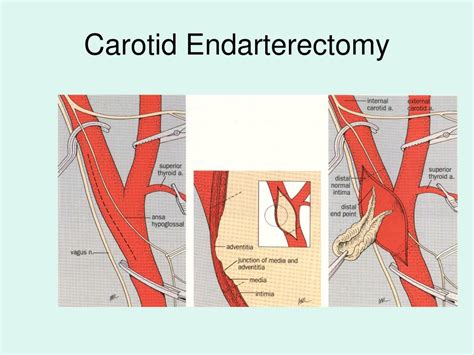 PPT - Surgical Intervention for Carotid Artery Disease PowerPoint ...