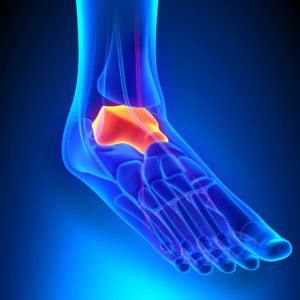 What Is OCD of the Ankle? | Bone Chip Doctor in Minneapolis