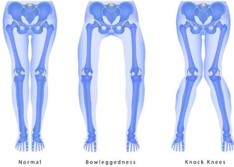 Knee Malalignment | Varus | Valgus| Sugar Land, Pearland, Houston, TX