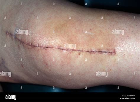 Knee surgery scar hi-res stock photography and images - Alamy