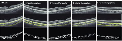 Horiztonal OCT scans where the top image is the initial OCT scan ...