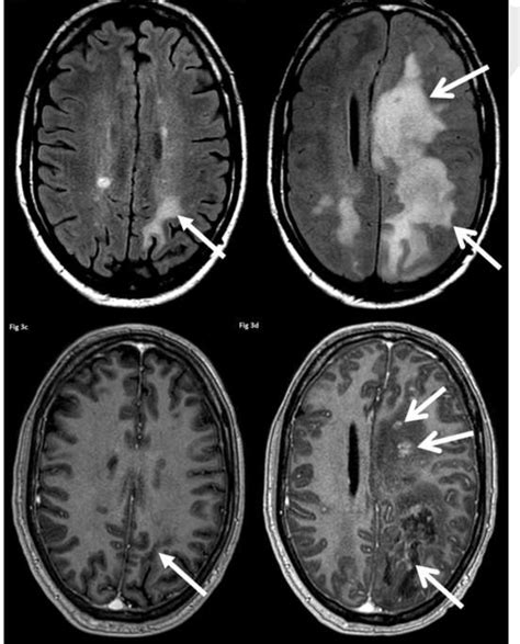 Figure 3 from Multiple sclerosis update: use of MRI for early diagnosis ...