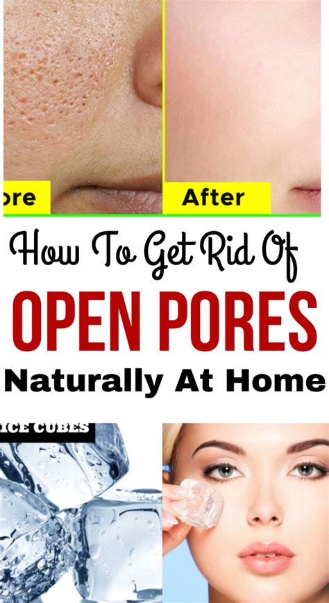 12 Home Remedies For Open Pores:Get Rid of at Home | Trabeauli | Skin ...