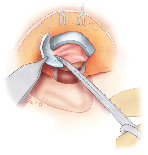 Postauricular Meatoplasty – Oto Surgery Atlas