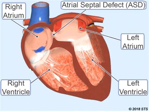 Atrial Septal Defect - Newport Cardiac & Thoracic Surgery