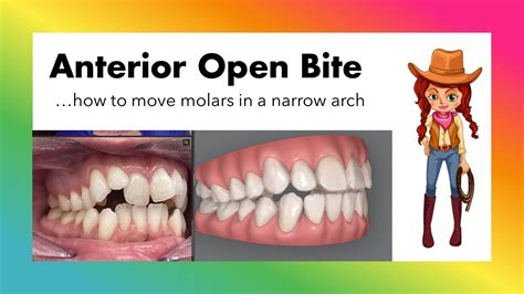 Invisalign ClinCheck - Anterior Open Bite with *predictable* molar ...