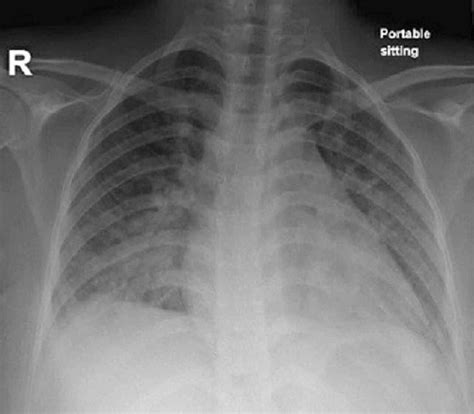 Edema Chest X Ray