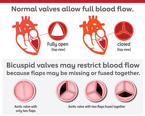 Aortic Valve Stenosis Vs Regurgitation - Lalocades