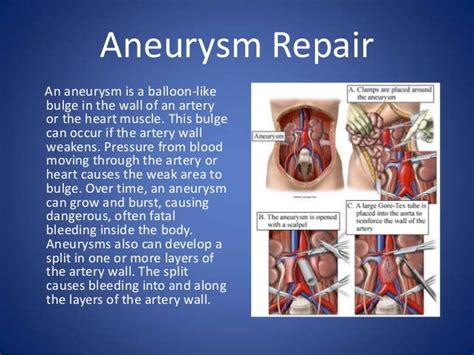 Types of Open Heart Surgery