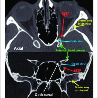 Diagrammatic representation of the right superior orbital fissure with ...