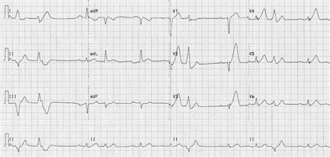 Anterior Myocardial Infarction Ecg