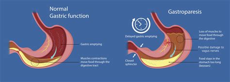 Gastroparesia ¿qué Es Causas Factores De Riesgo Síntomas 8856 | HOT ...