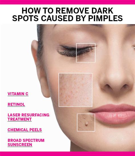 nothing promise Can be calculated how to remove black spots on skin ...