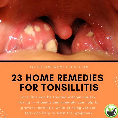 White Spots On Tonsils Treatment