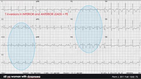 Pe ecg findings - vojordX