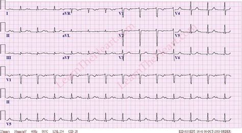 First Degree AV Block ECG 3 | LearntheHeart.com