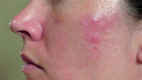 Cyst Acne Picture - Acne Picture