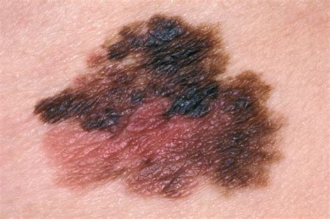 Skin cancer (melanoma) - Overview - HSE.ie