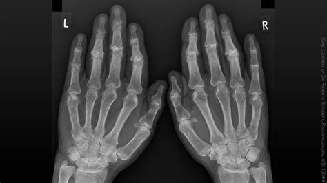 Rheumatoid Arthritis Hands X Ray