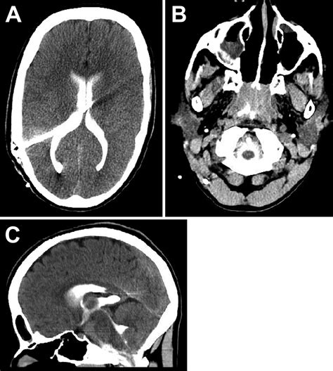 The role of lumboperitoneal shunts in managing chronic hydrocephalus ...