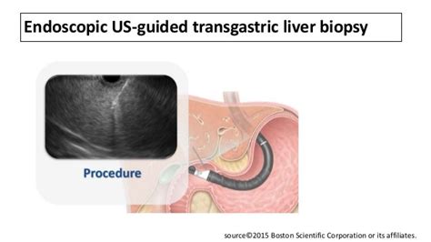 Liver biopsy